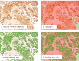  Imaging-Based Biomarker Helps Determine the Risk of Cardiac Amyloidosis 